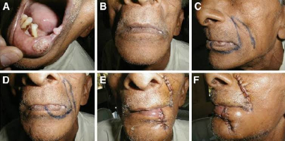 Oral cancer surgery